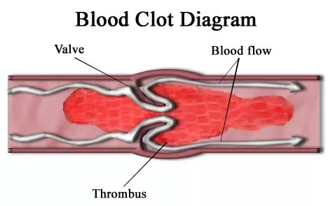 Bloot Clot in a Vein SimpleMed