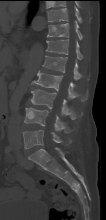 Osteoblastic Lesions SimpleMed