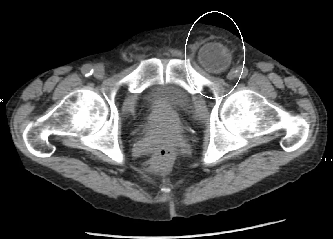 CT Scan of an Inguinal Hernia SimpleMed