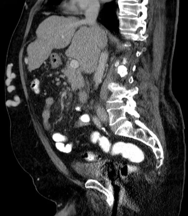 Caput Medusa on CT Scan SimpleMed