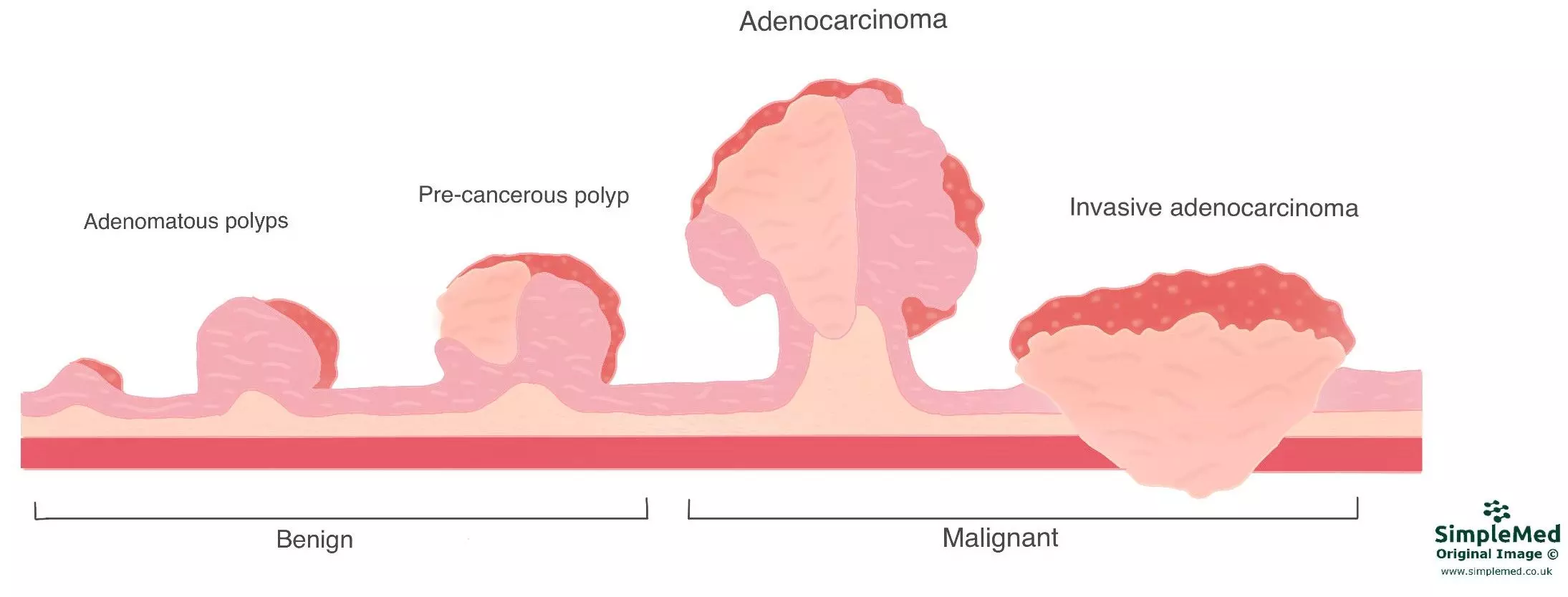 Carcinoma to Adenocarcinoma Progression SimpleMed