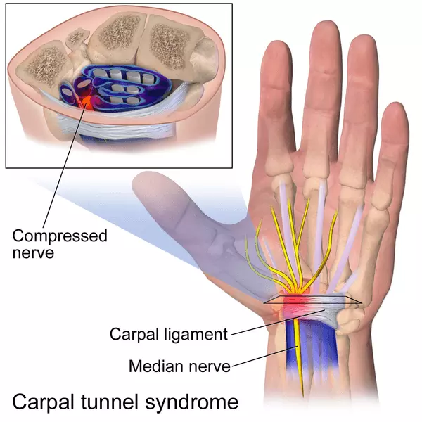 Carpal Tunnel Syndrome SimpleMed