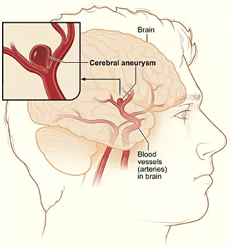 Cerebral Aneurysm SimpleMed