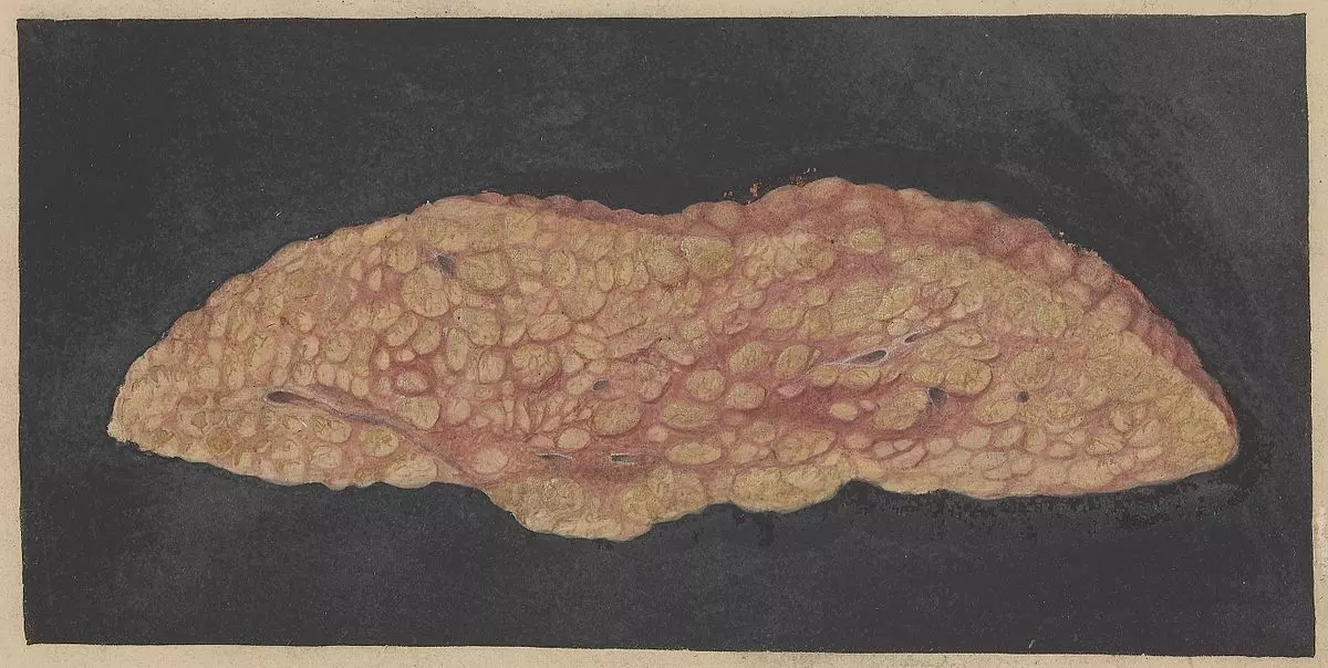 Cirrhotic Liver with Fatty Degeneration SimpleMed