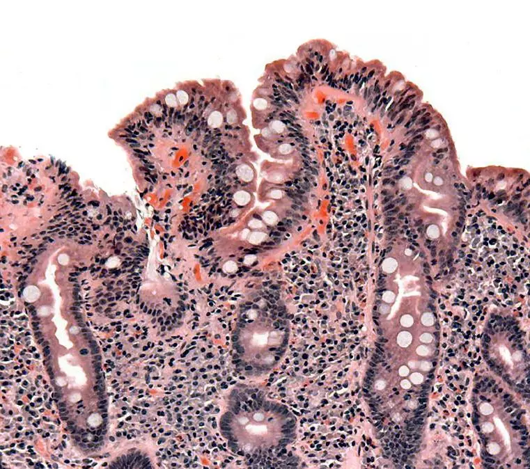 Coeliac Histology with Atrophic Villi SimpleMed