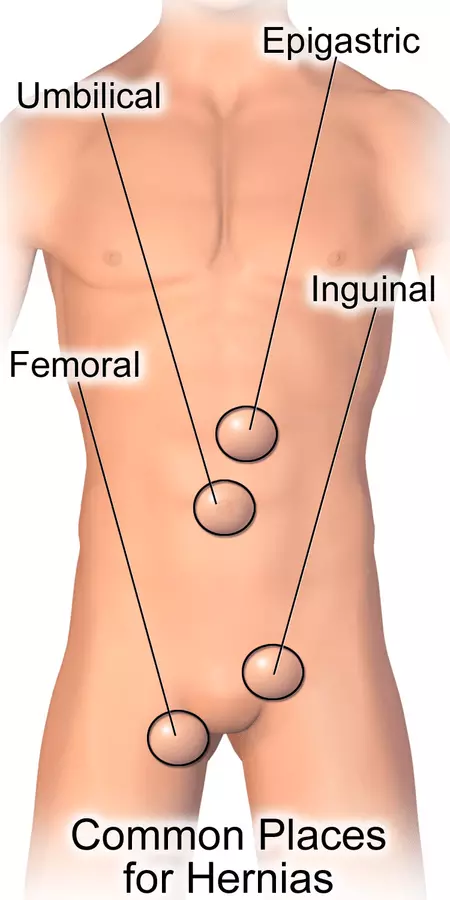 Common Sites of Hernias SimpleMed