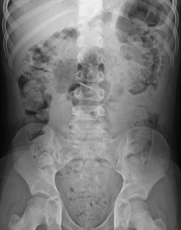 Constipation on an Abdominal X-ray SimpleMed