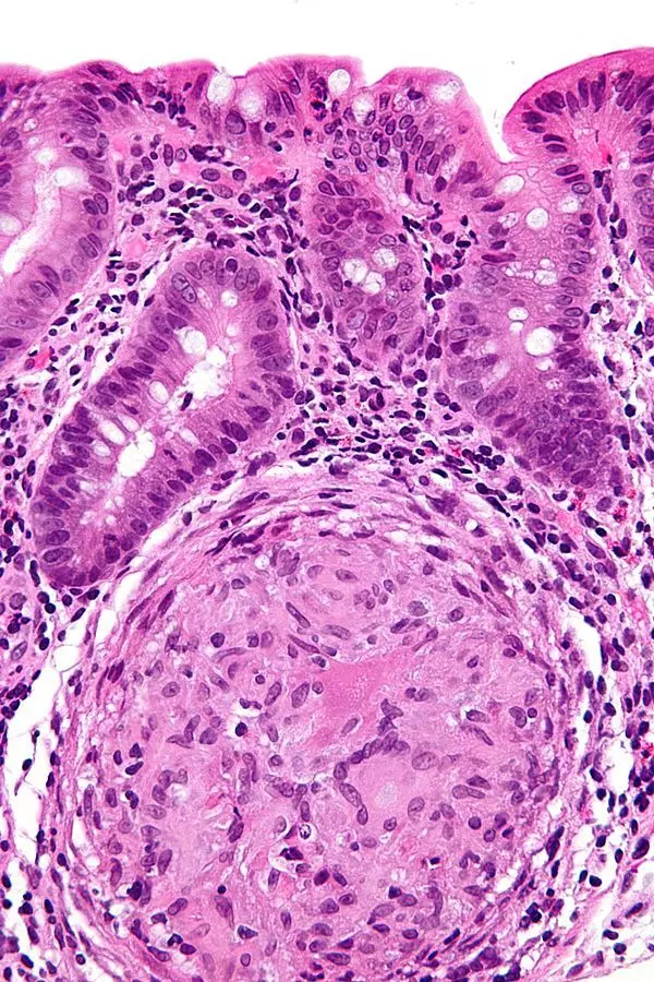 Crohn's Disease Histology with Granuloma SimpleMed