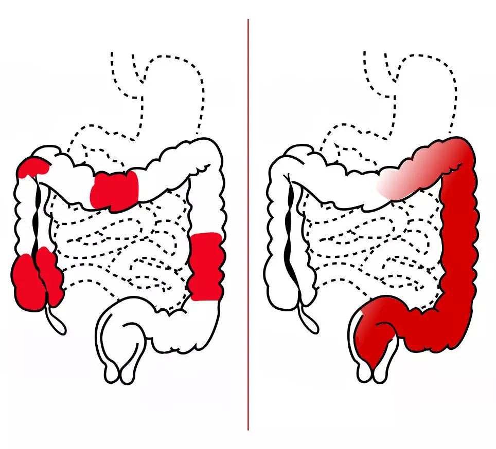 Pattern of Disease in Crohn's vs UC SimpleMed