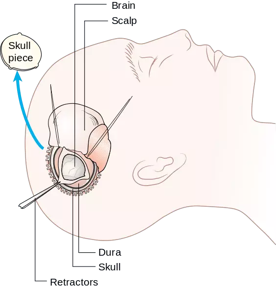 Decompressive Craniectomy SimpleMed