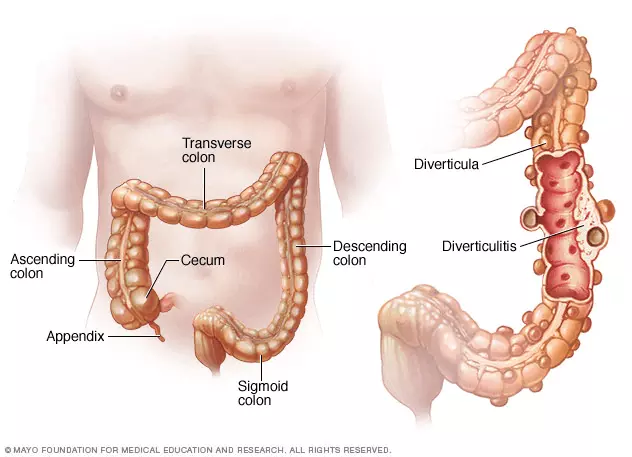 Diverticular Disease SimpleMed