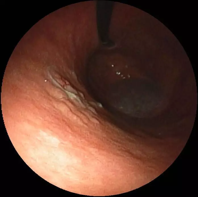 Early Gastric Cancer SimpleMed