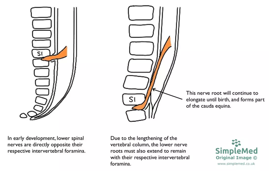 Elongation of the Spinal Cord SimpleMed