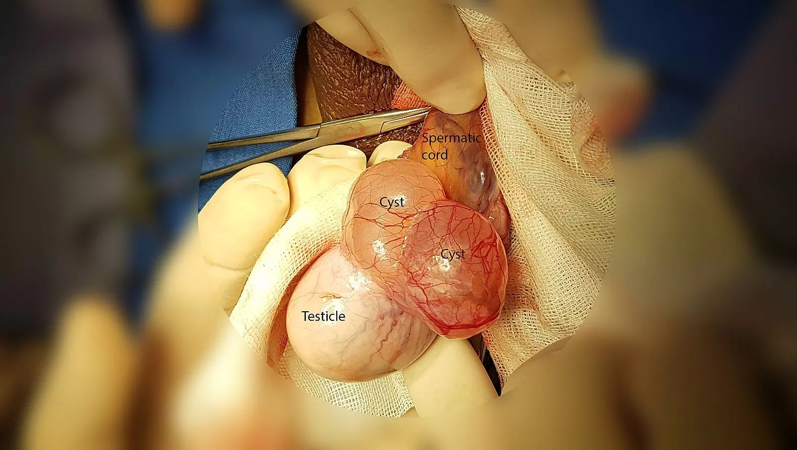 Epididymal Cysts SimpleMed