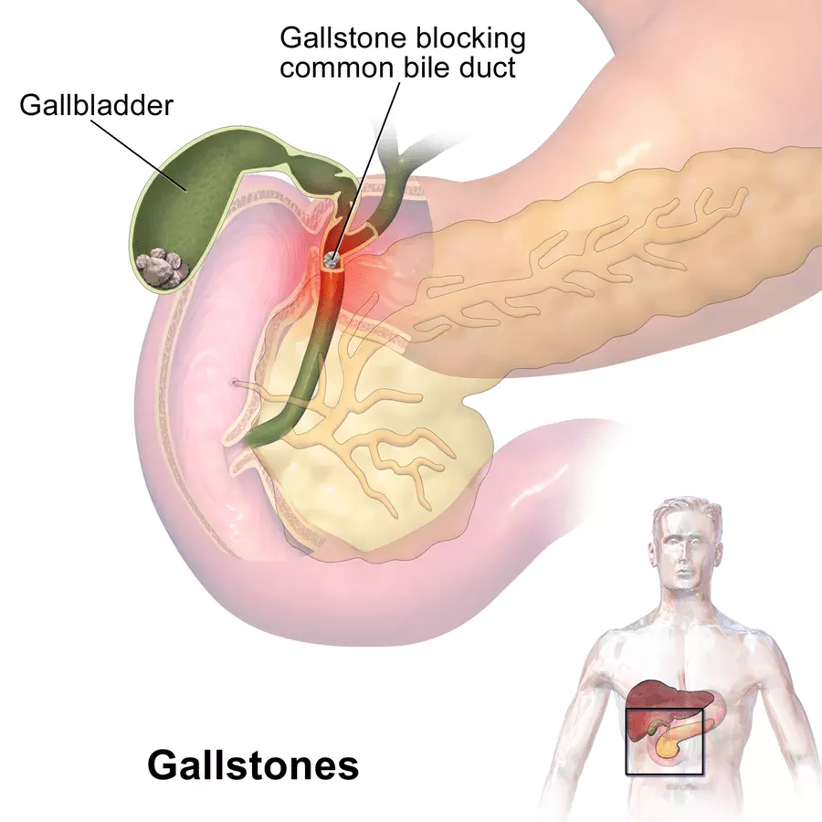 Gallstones Blocking the Common Bile Duct SimpleMed