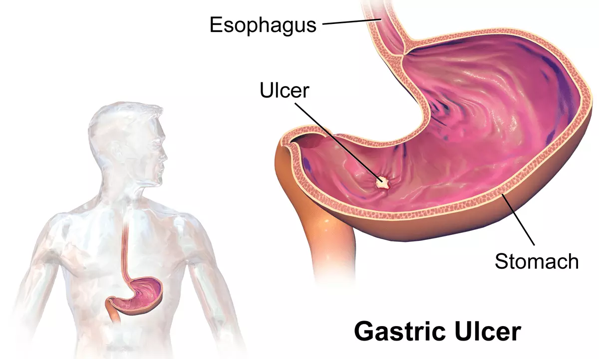 Gastric Ulcer SimpleMed