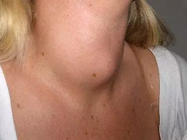 Goitre female enlarged thyroid SimpleMed