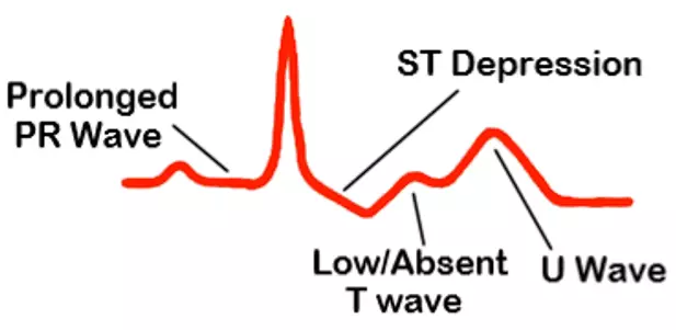 ECG Changes in Hypokalaemia SimpleMed