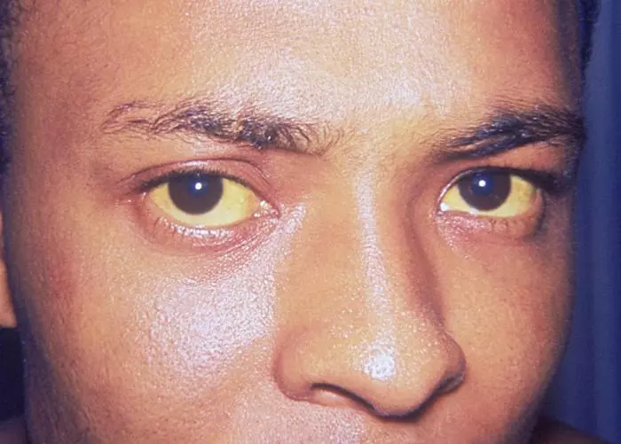 Jaundice of the Sclera SimpleMed