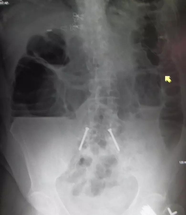 Large Bowel Obstruction Abdominal X-ray SimpleMed