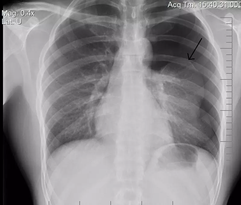 Left Sided Pneumothorax SimpleMed