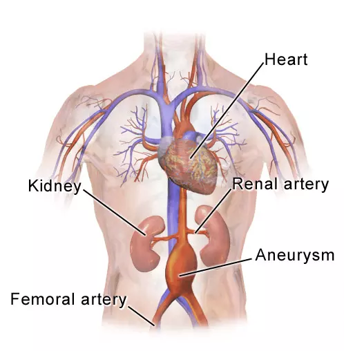 Location of Abdominal Aortic Aneurysm SimpleMed
