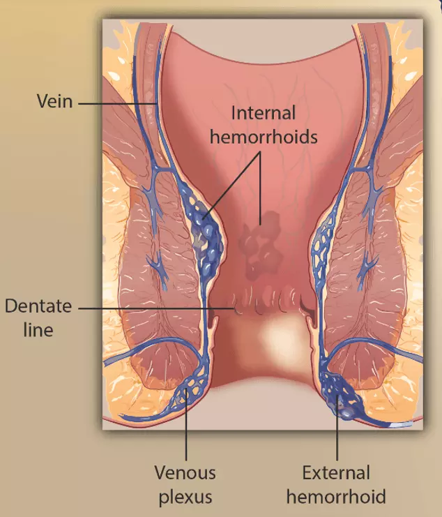 Locations of Haemorrhoids SimpleMed