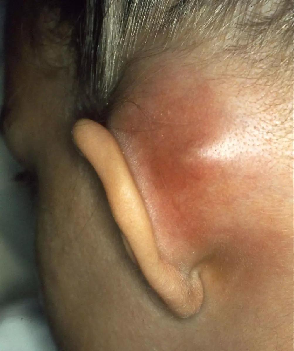 Mastoiditis SimpleMed