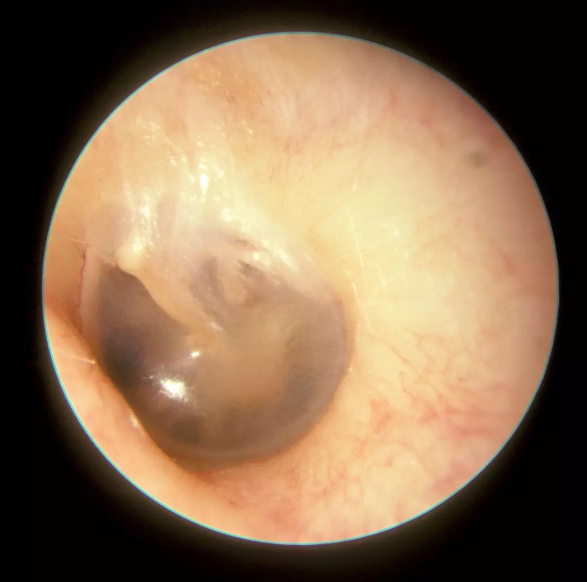 Otoscopy of a Normal Left Tympanic Membrane SimpleMed