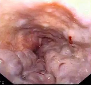 Oesophageal Varices SimpleMed