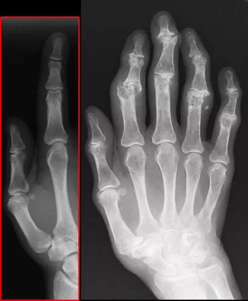 Osteoarthritis Affecting the Fingers With Heberden's and Bouchard's Nodes SimpleMed