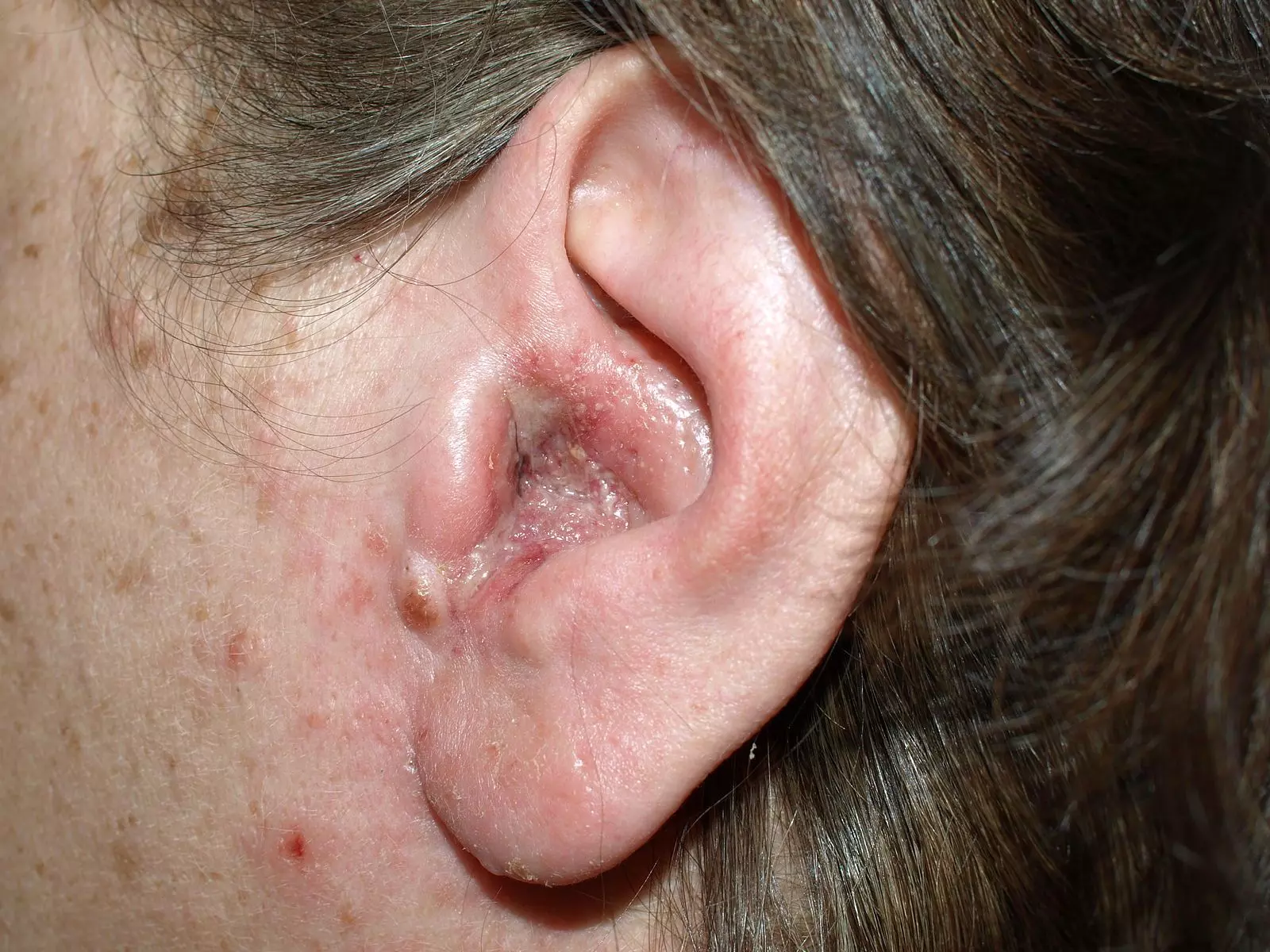Otitis Externa SimpleMed