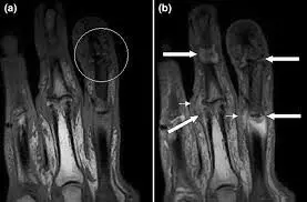 Psoriatic Arthropathy Affecting the Fingers SimpleMed