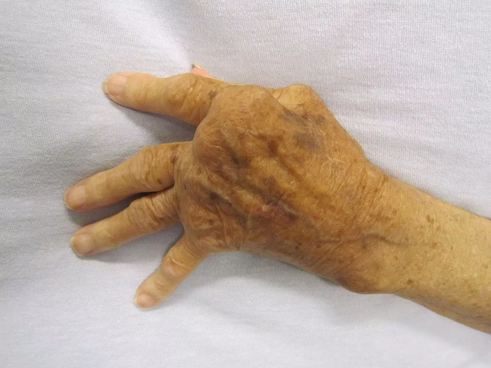 Rheumatoid Arthritis Hand SimpleMed