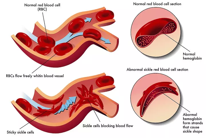 Sickle Cell Anaemia Blocking Blood Vessels SimpleMed