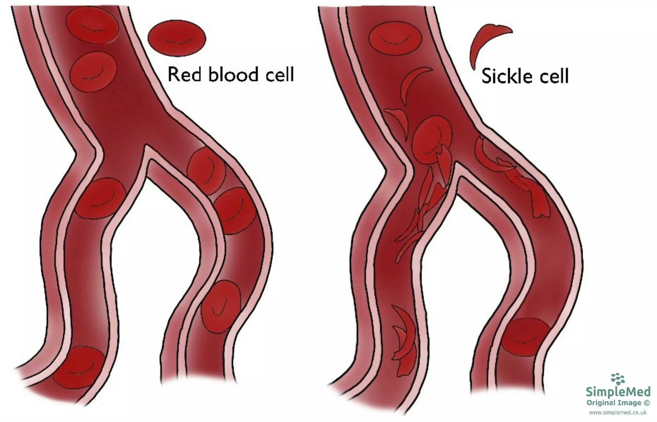 Sickle Cell Anaemia Blood Vessels Diagram SimpleMed