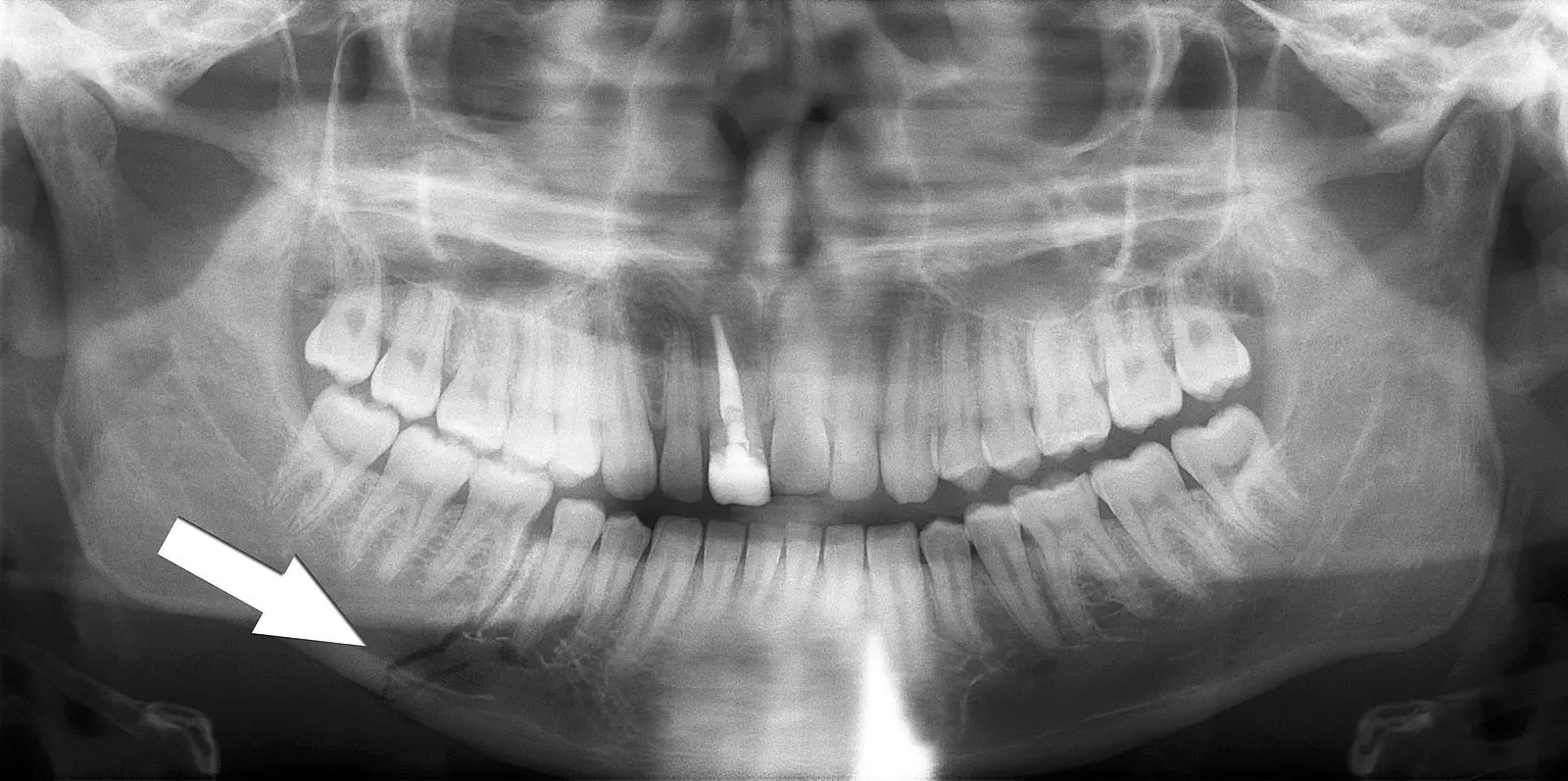 Simple Mandible Fracture X-ray SimpleMed