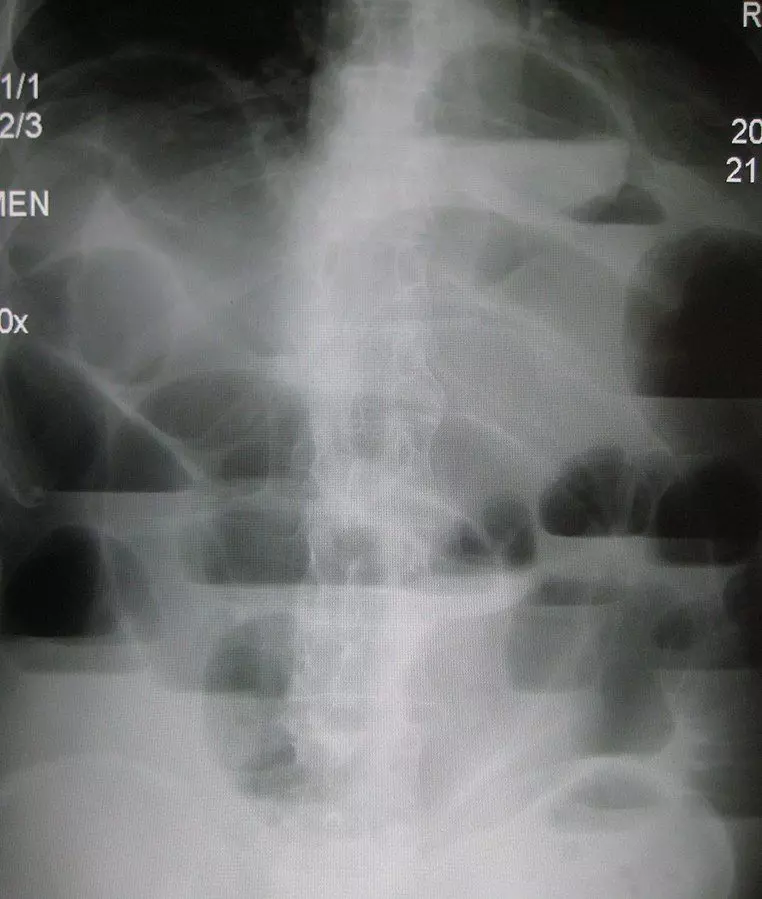 Small Bowel Obstruction X-ray SimpleMed