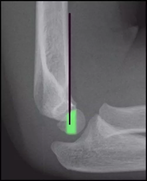Supracondylar Fracture of the Distal Humerus X-Ray SimpleMed