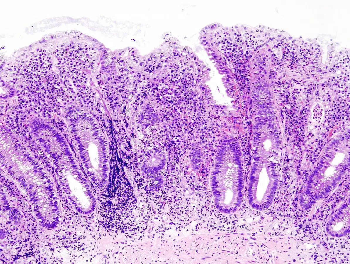 Ulcerative Colitis Endoscopic Biopsy SimpleMed