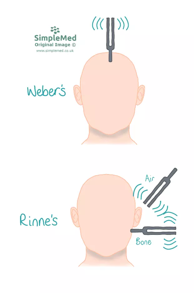 Weber's and Rinne's Test SimpleMed