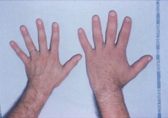 Acromegaly Hands SimpleMed