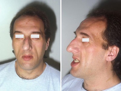 Acromegaly Prognathism SimpleMed