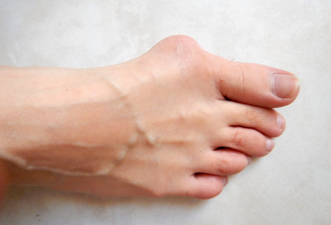 Hallux valgus deformity of the great toe SimpleMed