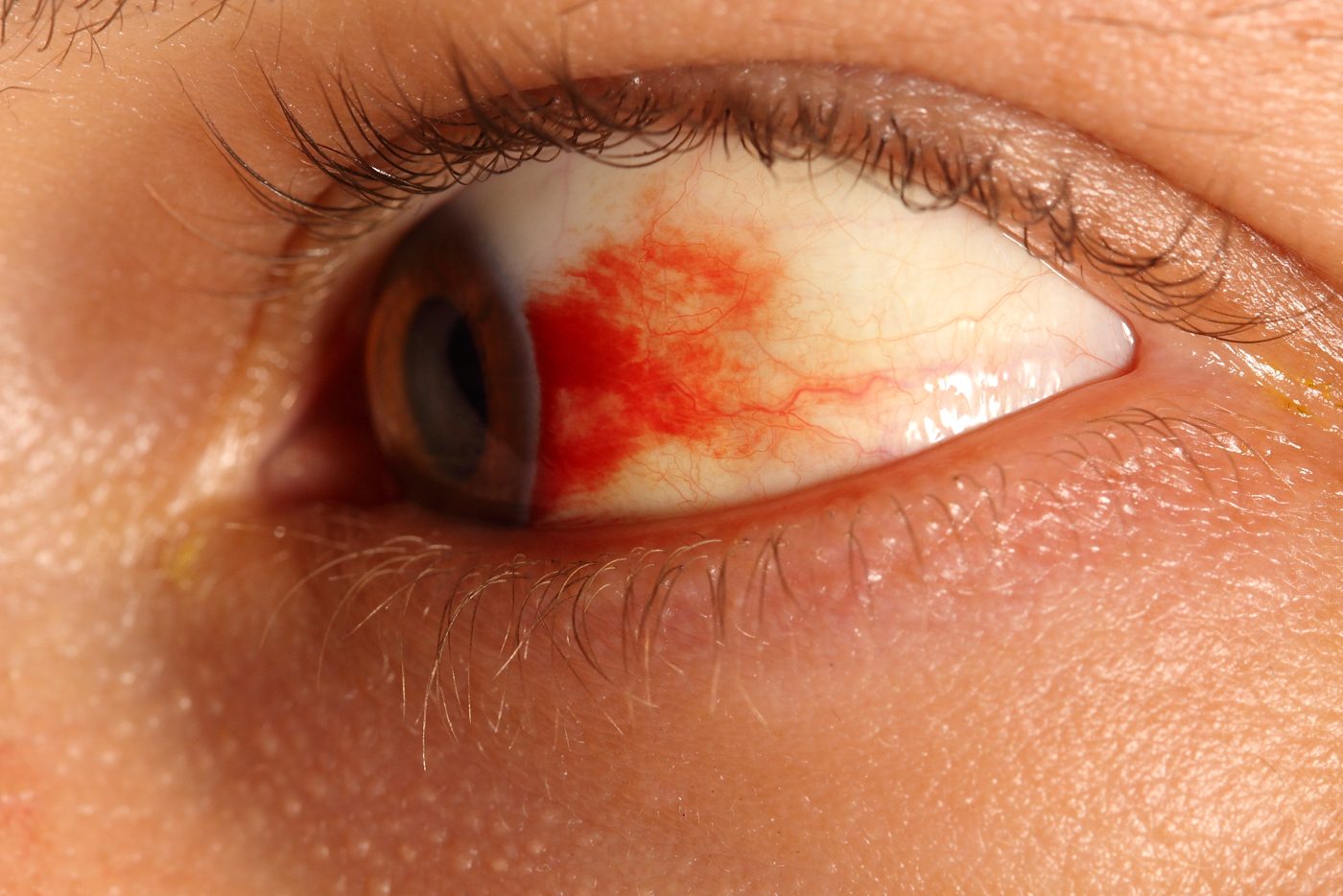 Subconjunctival Haemorrhage SimpleMed