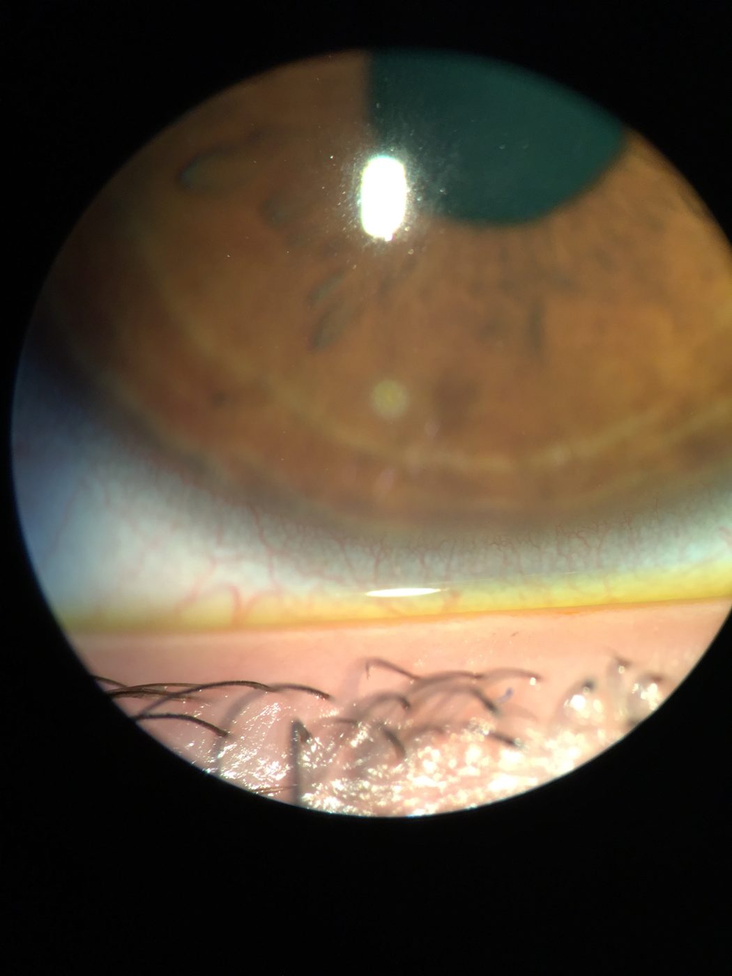 Corneal Ulcer Fluorescein Staining SimpleMed