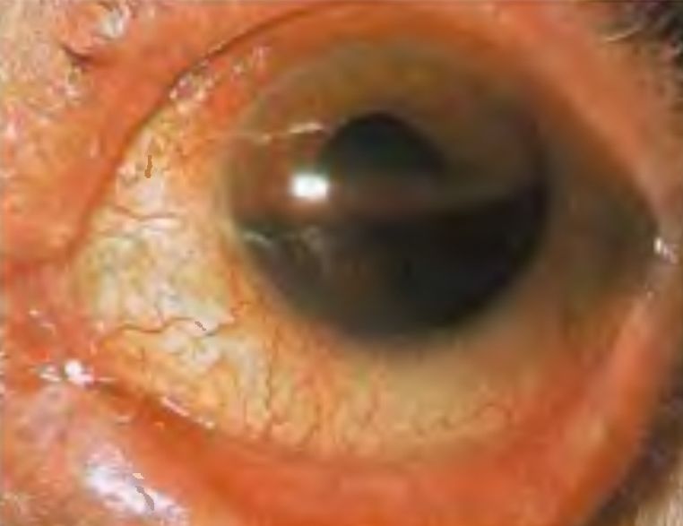 Hyphaema SimpleMed