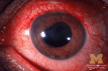 Anterior Uveitis SimpleMed