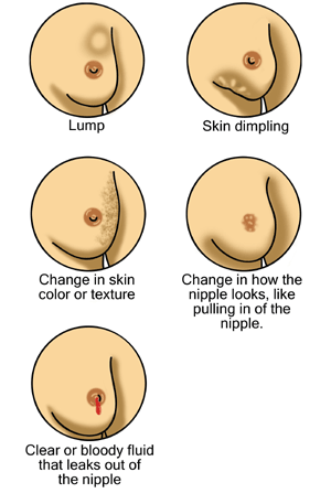 Illustrations of early breast cancer signs including lump, skin dimpling, skin texture change, nipple inversion and nipple discharge