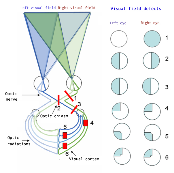 Visual Field Defects SimpleMed